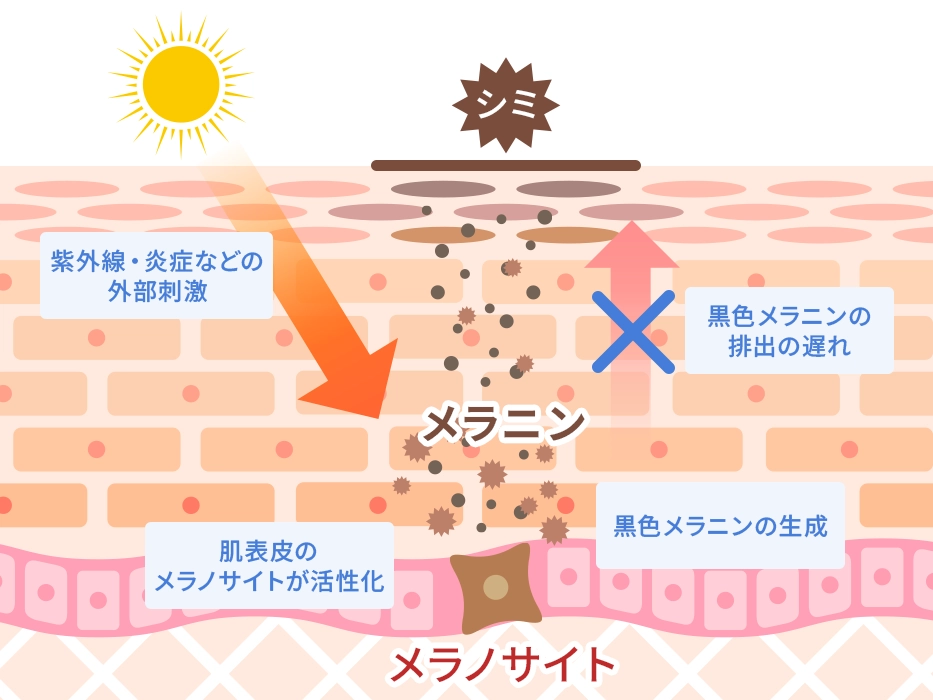シミができるメカニズム