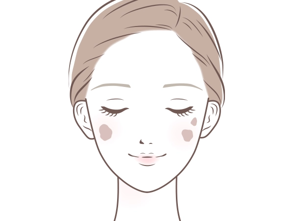 老人性色素斑