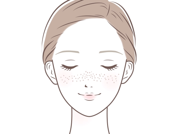そばかす（雀卵斑）