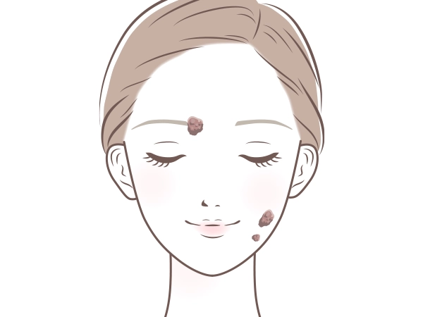 脂漏性角化症（老人性イボ）