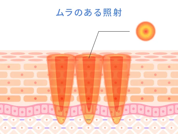 ムラのある照射