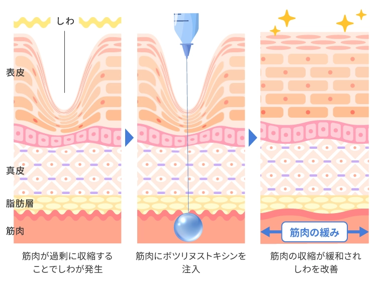 ボトックス注射の作用
