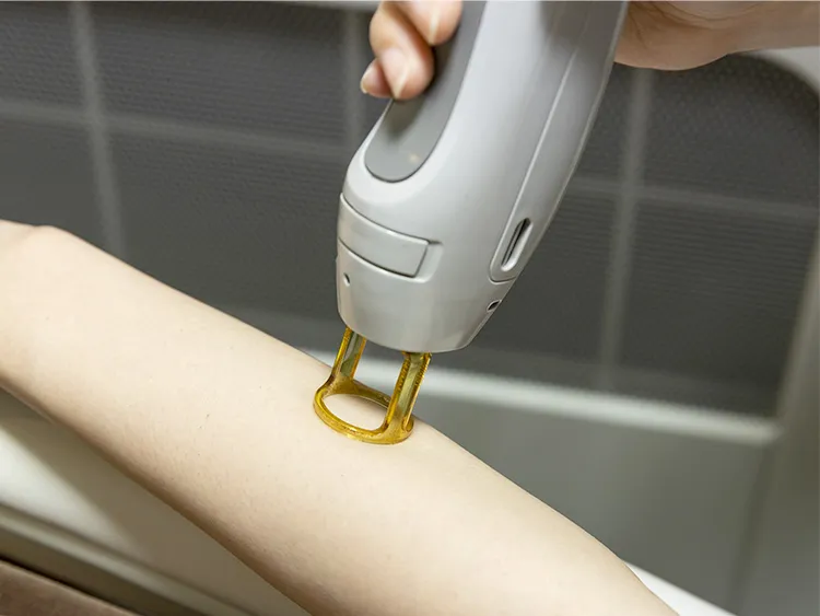 医療レーザーの照射