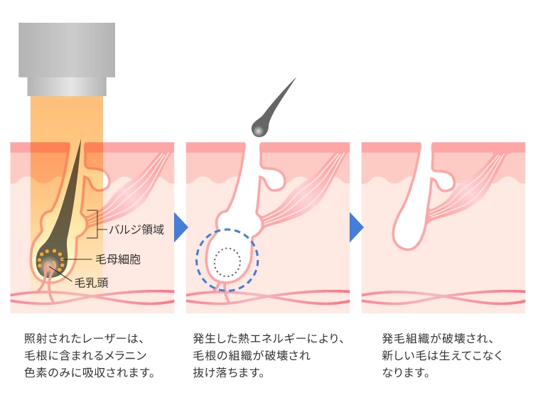 医療脱毛のメカニズム