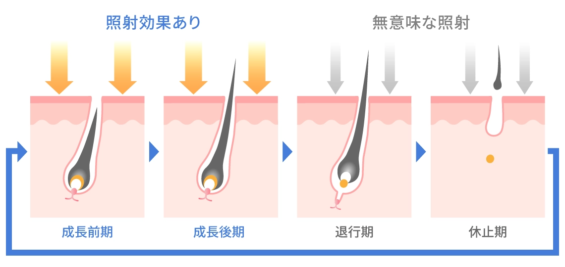 レーザー脱毛の効果が最も高い成長期