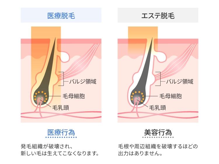 医療脱毛とエステ脱毛の違い