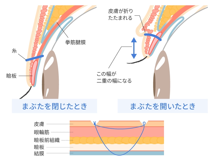 埋没法の仕組み