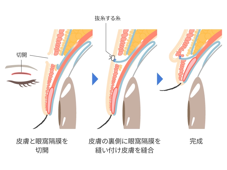 二重切開の仕組み