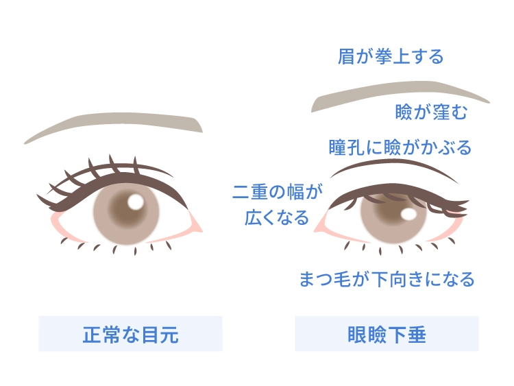 正常な目元と眼瞼下垂の目元の比較・特徴