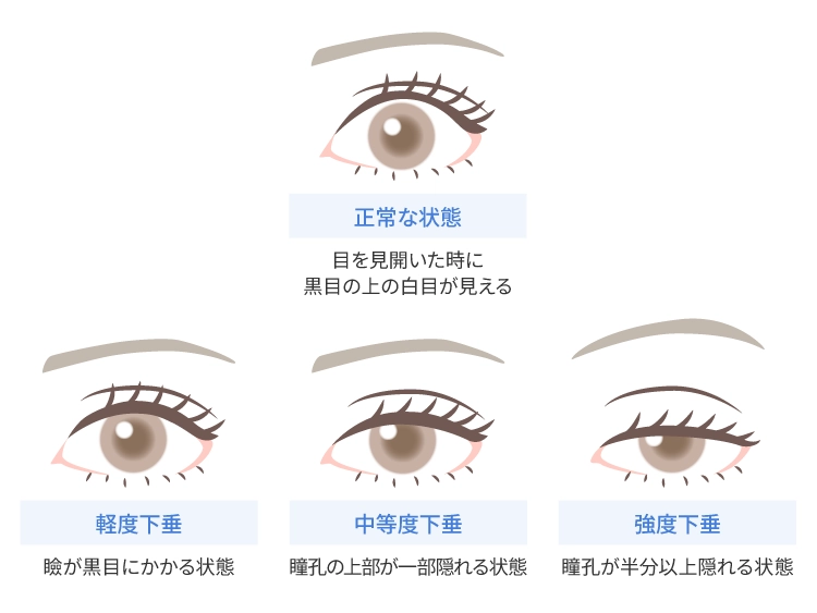 眼瞼下垂の重症度