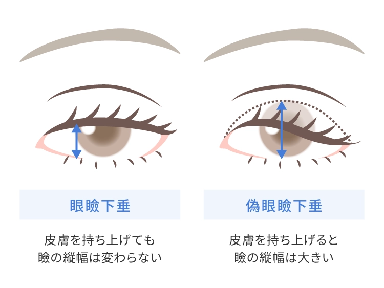 眼瞼下垂と偽眼瞼下垂の違い