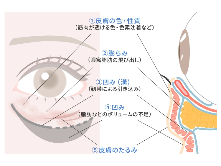 目の下のたるみの原因