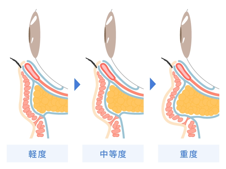 眼窩脂肪の重症度