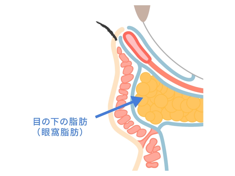 眼窩脂肪とは