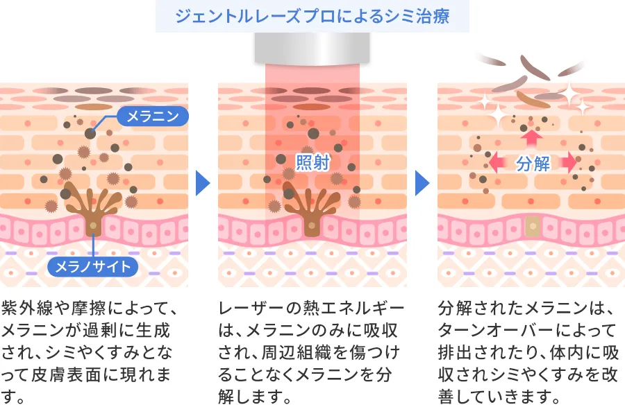 ジェントルマックスプロによるシミ治療