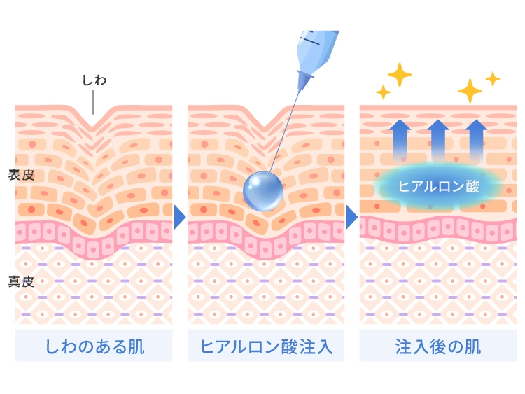 ヒアルロン酸注射の仕組み