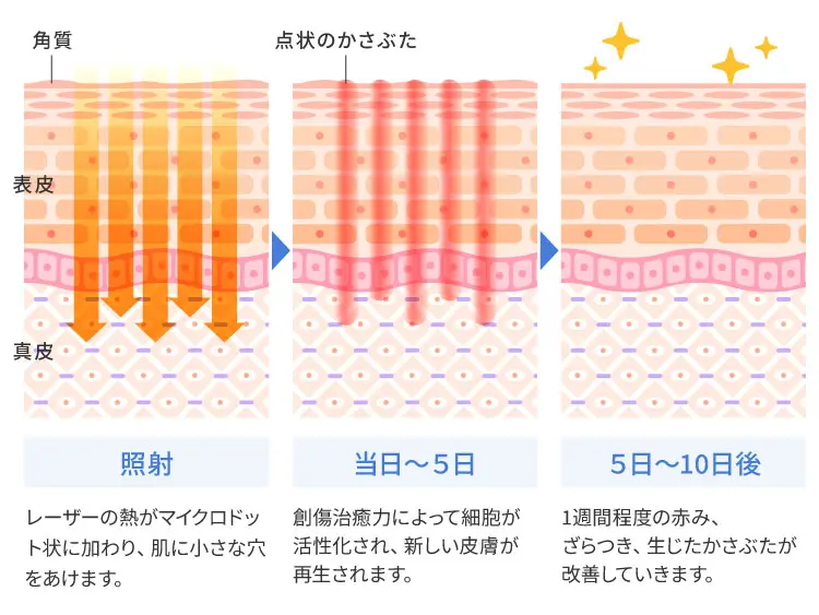 フラクショナルCO2レーザーとは？