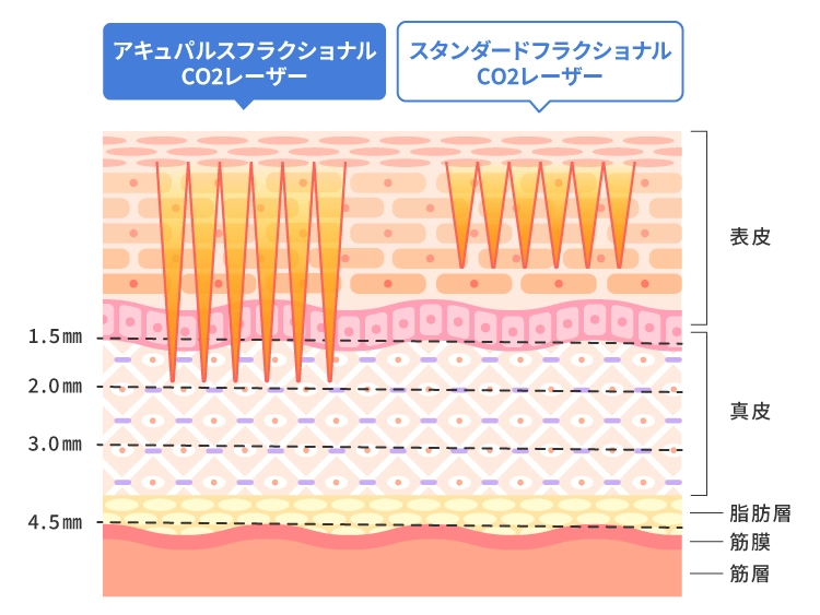 アキュパルス とスタンダードの違い