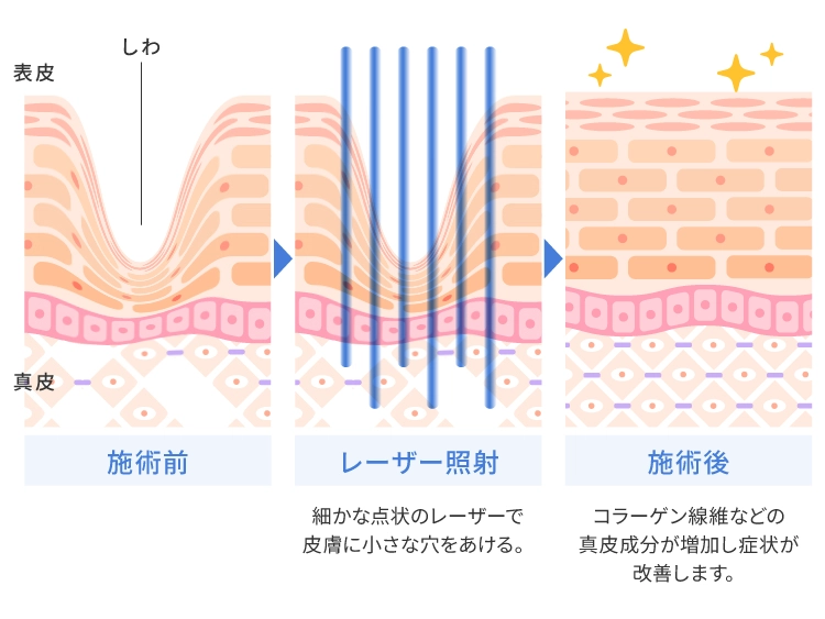 フラクショナルCO2レーザーによるしわの改善