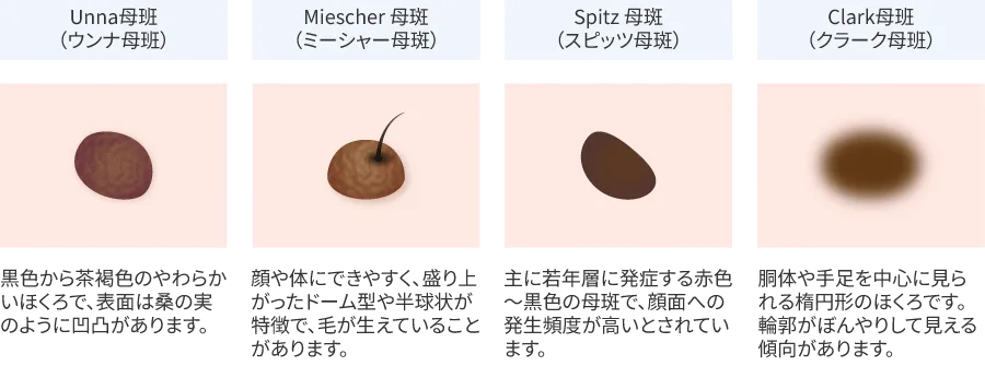 ほくろの種類