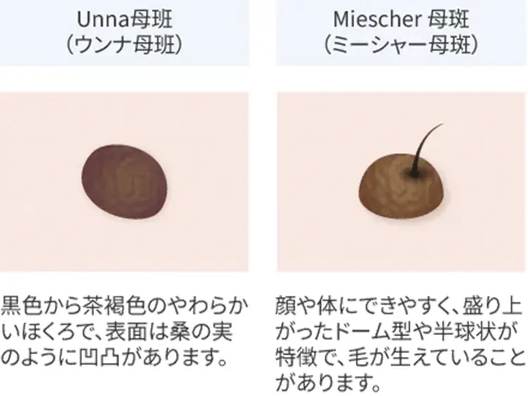 ほくろの種類