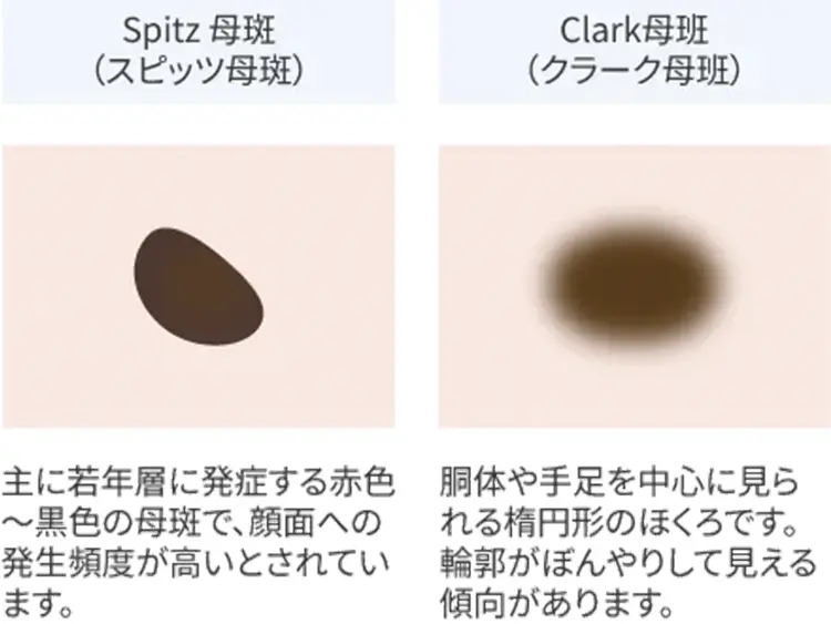 ほくろの種類