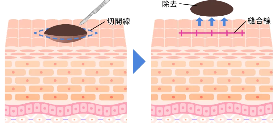 切開法による除去
