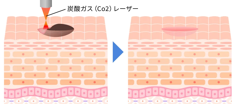 レーザー治療による除去