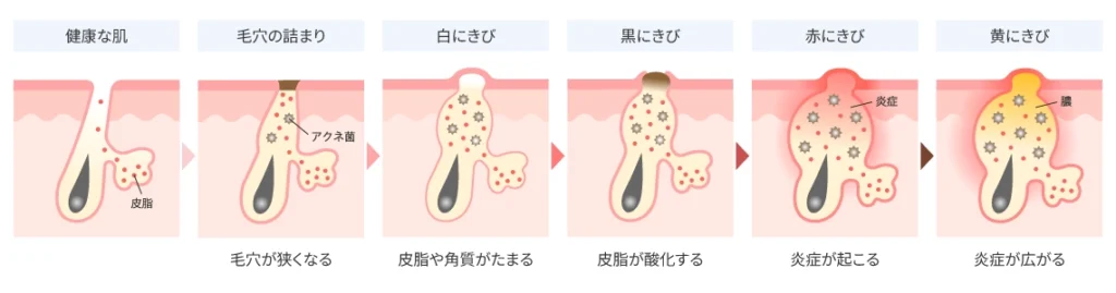 にきびの炎症が進行するまでの基本的な流れ