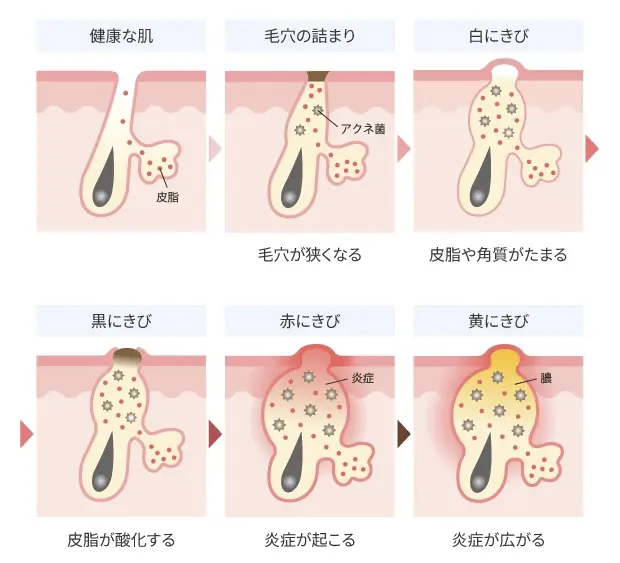 にきびの炎症が進行するまでの基本的な流れ