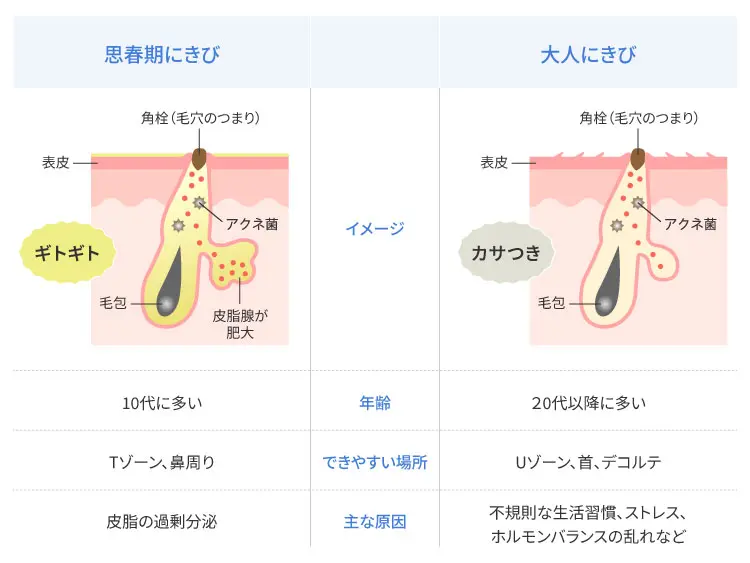 大人にきびと思春期にきびの違い