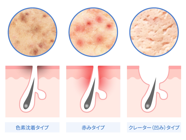 にきび跡の種類・タイプ