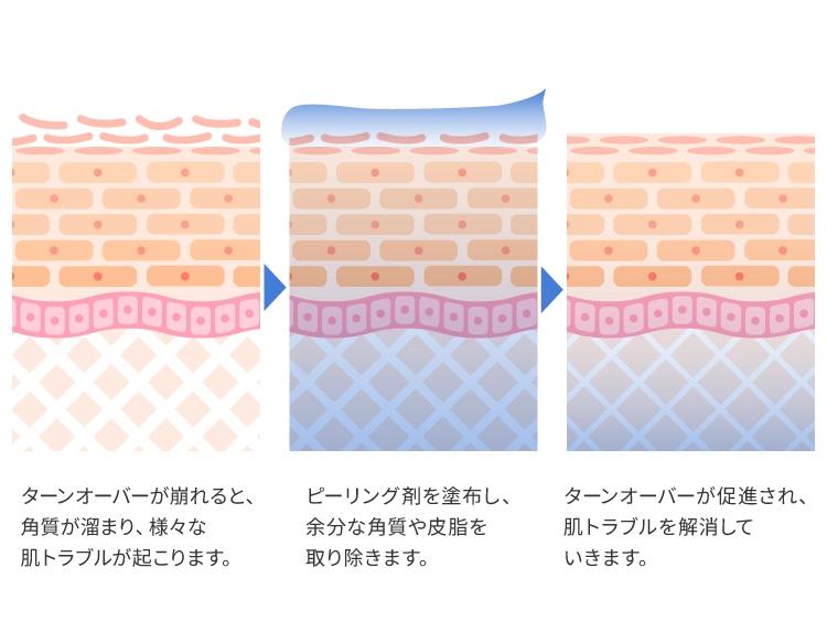 ケミカルピーリングとは？