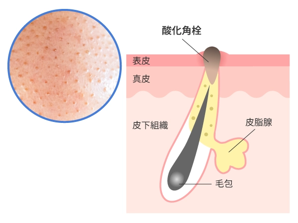 黒ずみ毛穴