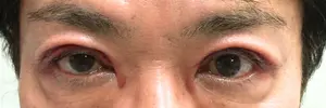 眼瞼下垂の施術直後