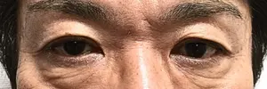 眼瞼下垂の施術前
