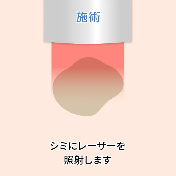 シミ取りレーザー後の経過：治療直後
