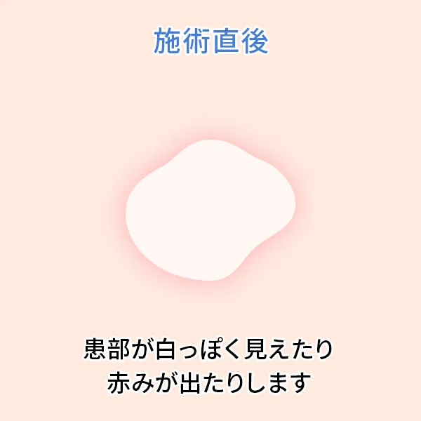 シミ取りレーザー後の経過：治療直後