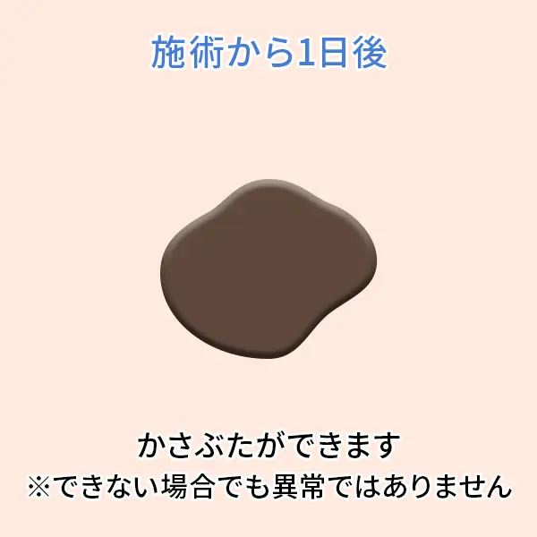 シミ取りレーザー後の経過：10〜14日後