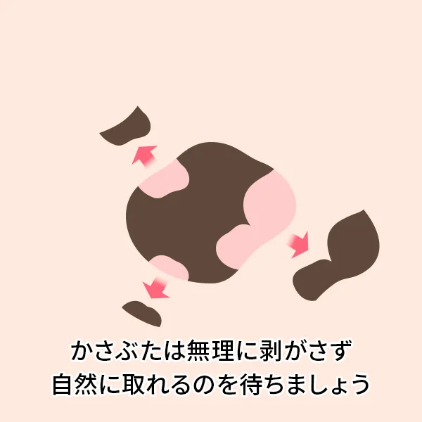 シミ取りレーザー後の経過：10〜14日後