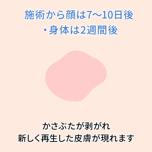 シミ取りレーザー後の経過：1ヶ月後