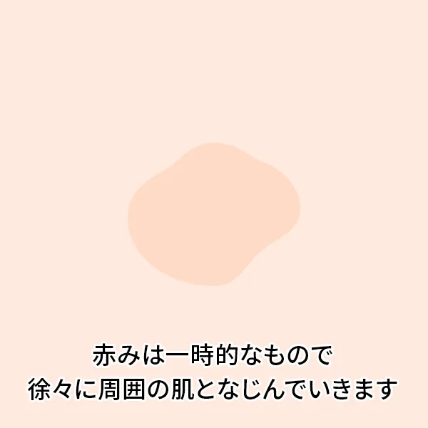シミ取りレーザー後の経過：1ヶ月後