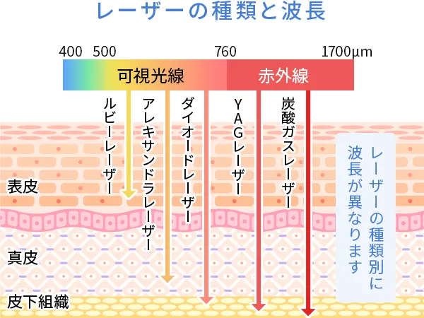 美容レーザーの種類