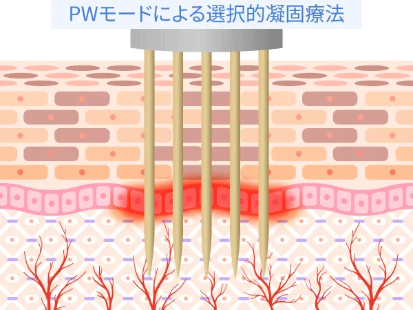 PWモードによる選択的凝固療法