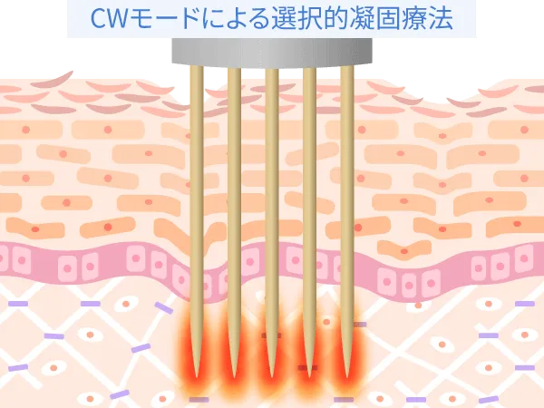 CWモードによる非選択的凝固法
