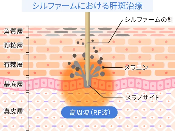 シルファームによる肝斑治療