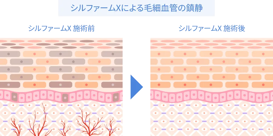 シルファームXによる毛細血管の鎮静