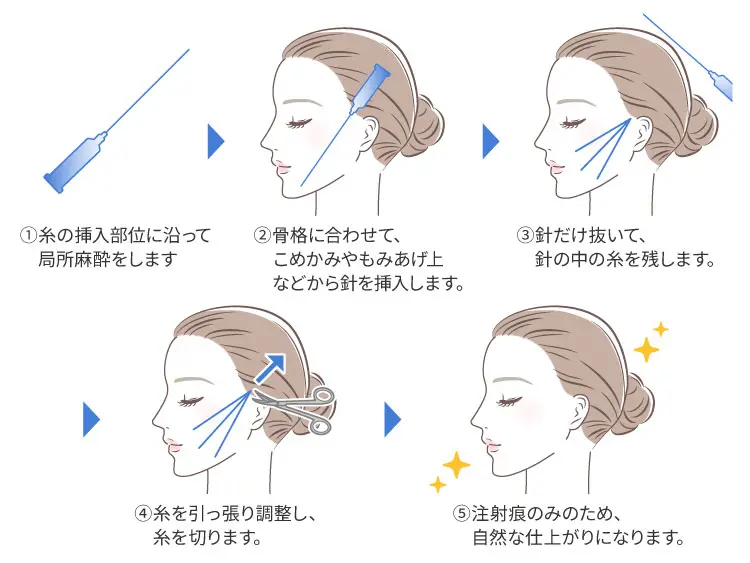 糸リフトの仕組み