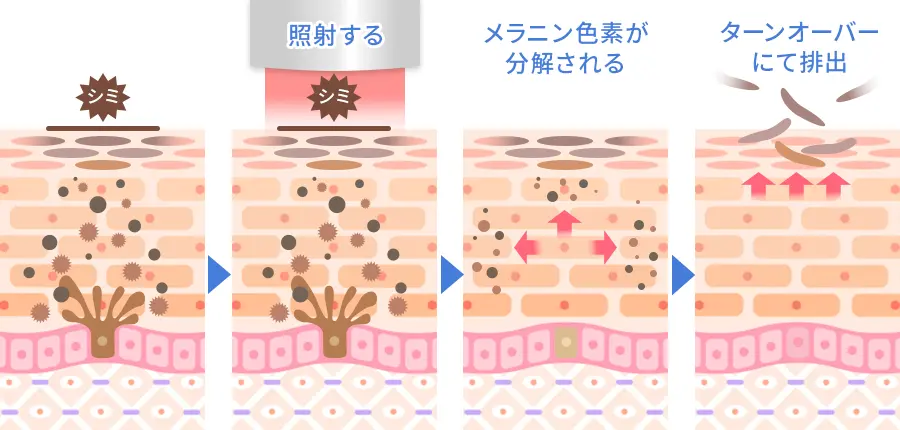 レーザートーニングの効果