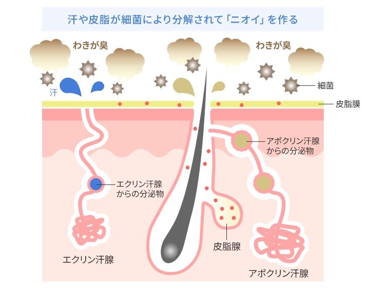 わきが(腋臭症)の原因
